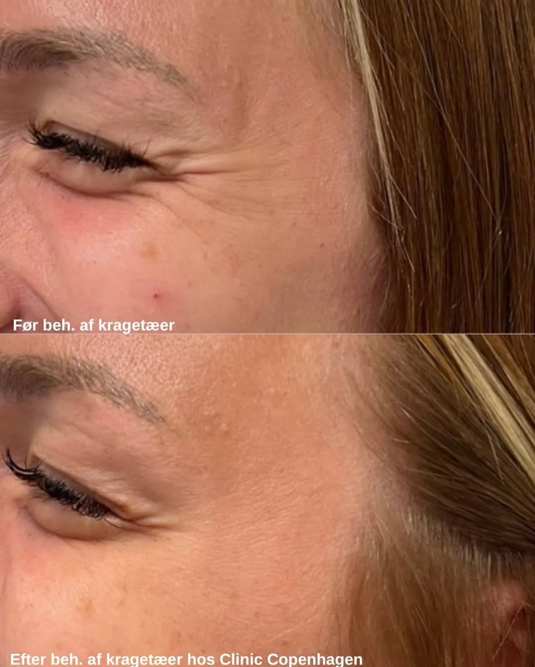 Botox crow's feet before and after — smoother eye area