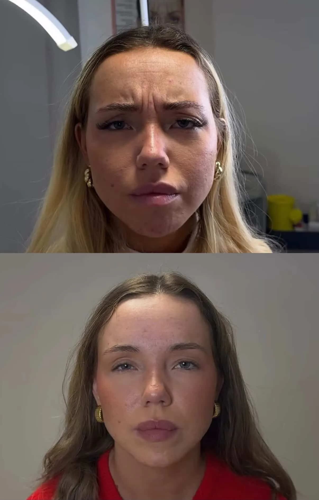 What is Botox? A complete guide