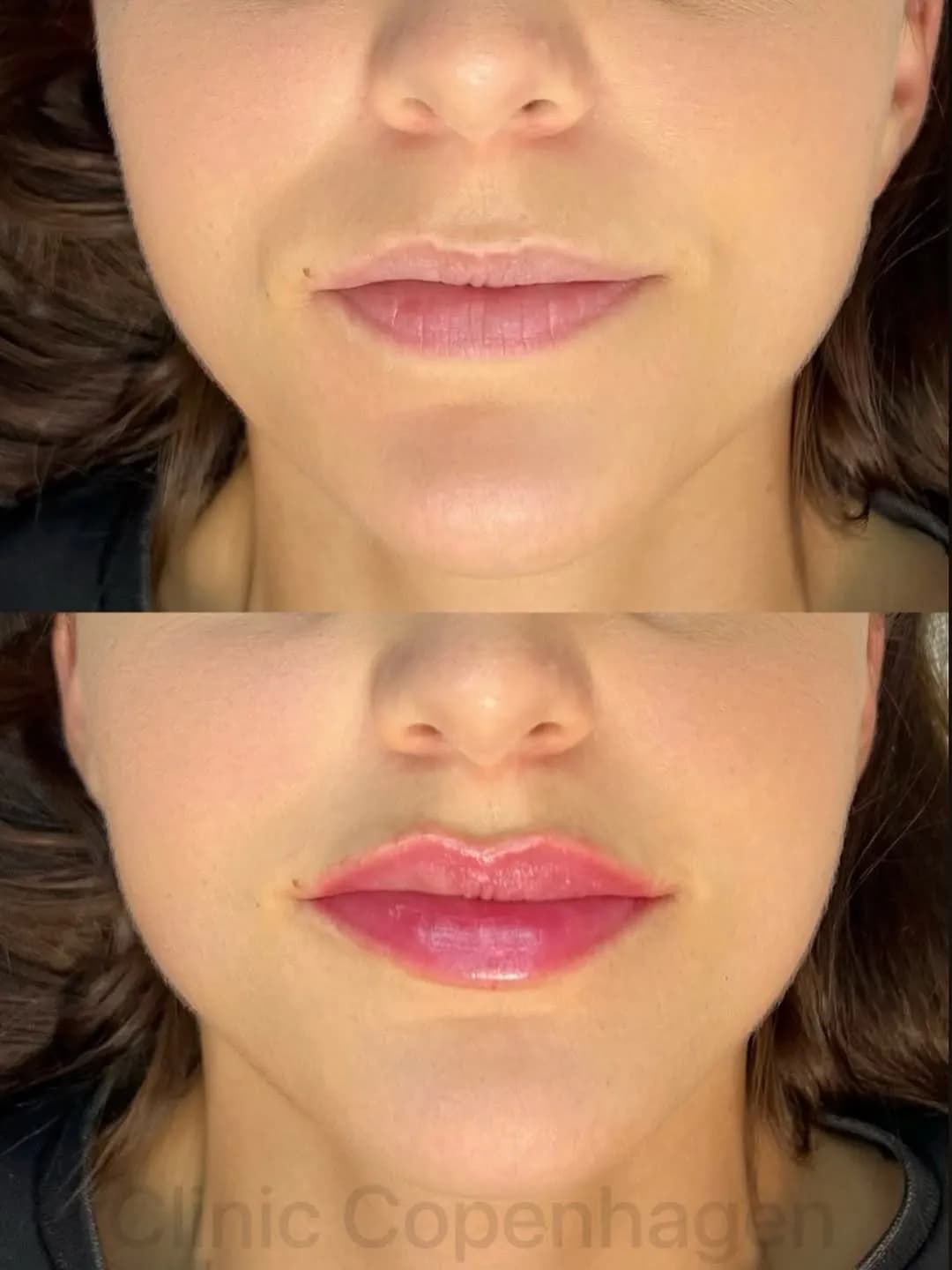 CC Lips result — subtle enhancement without overdone features