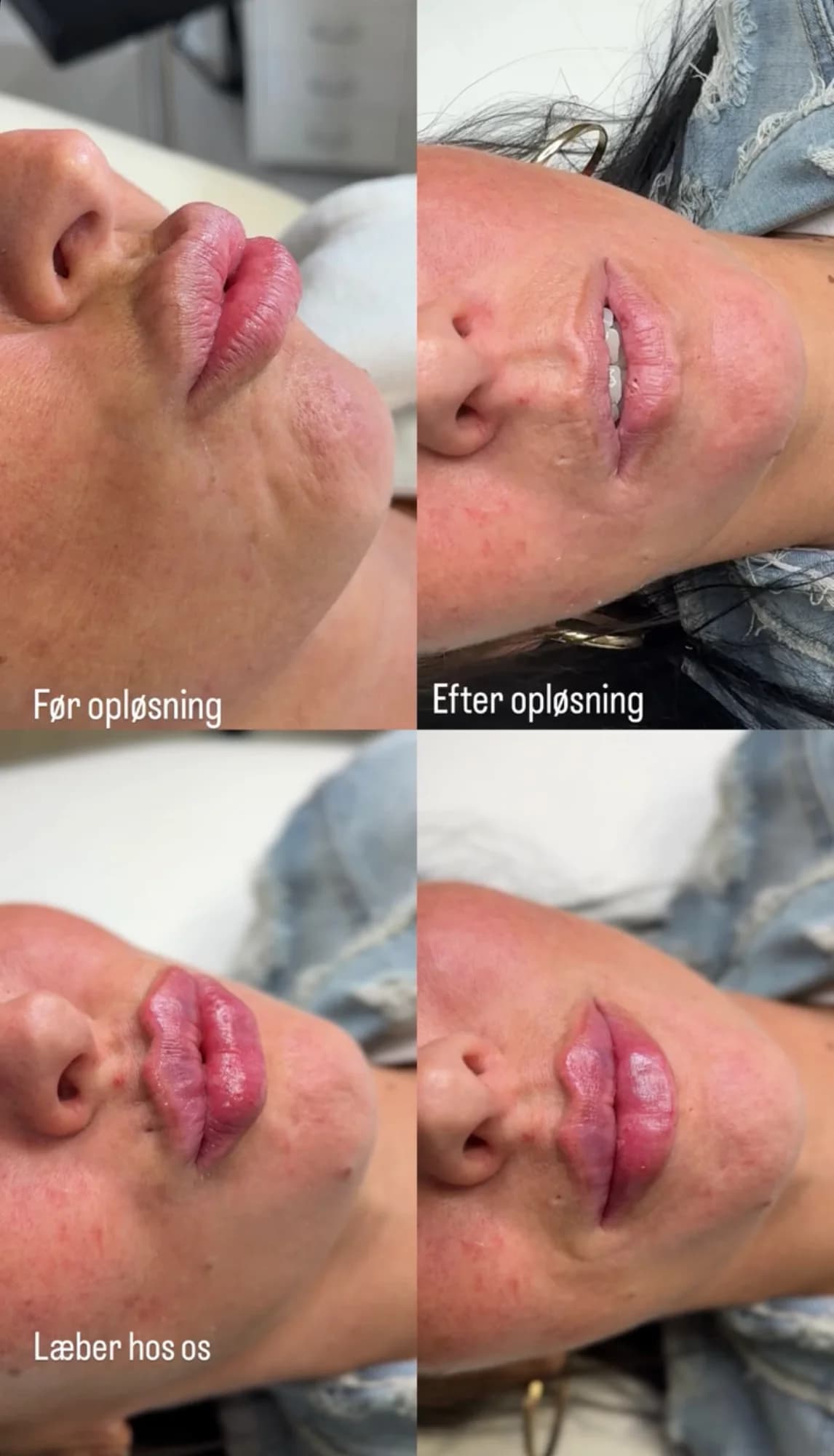 Opløsning af filler — Hyalase-behandling i København