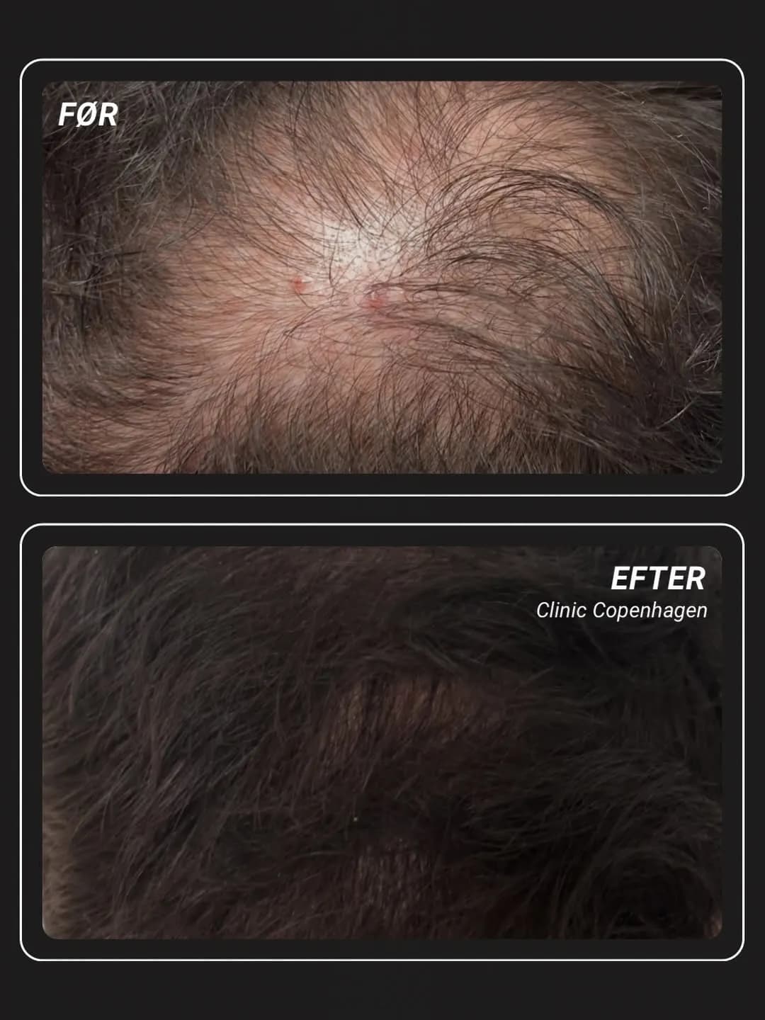 PRF hair treatment — before and after 6 months at Clinic Copenhagen