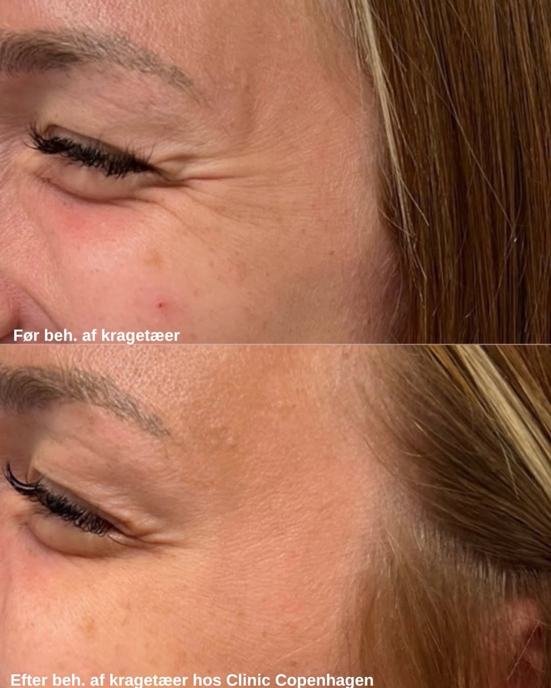 Botox kraget&aelig;er — f&oslash;r og efter