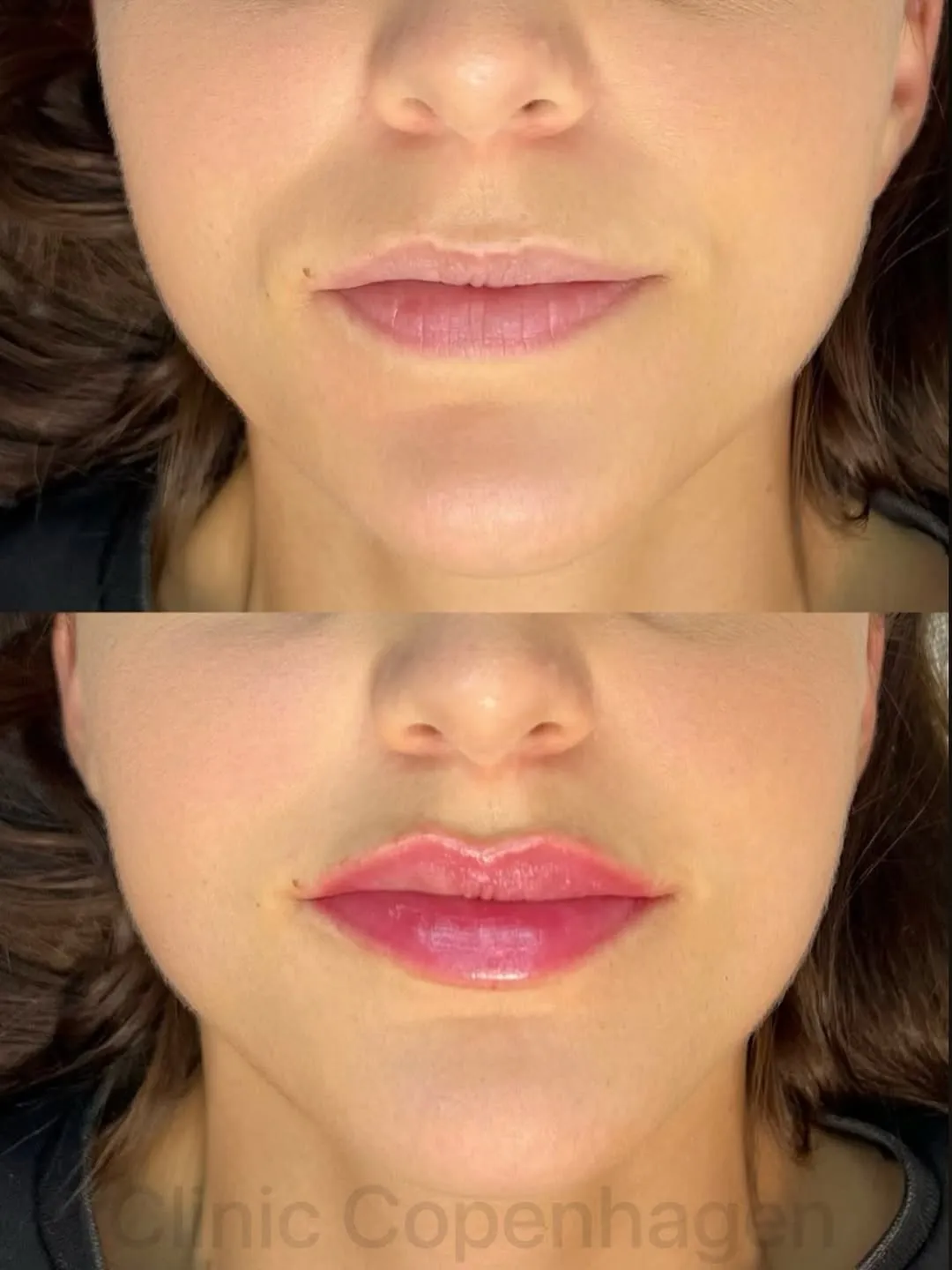 CC Lips naturligt resultat hos Clinic Copenhagen