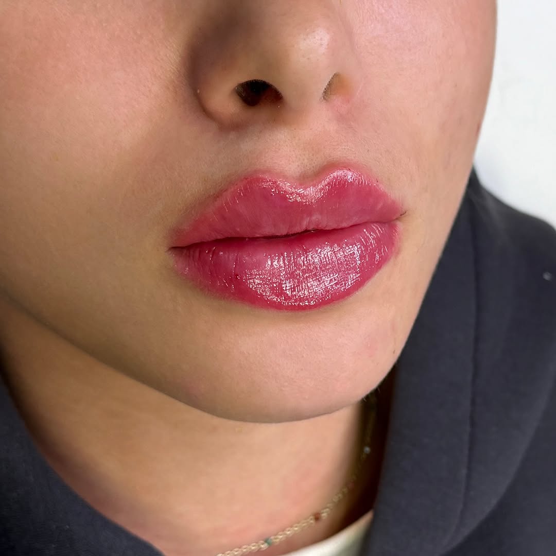 Filler resultat — facial balancing