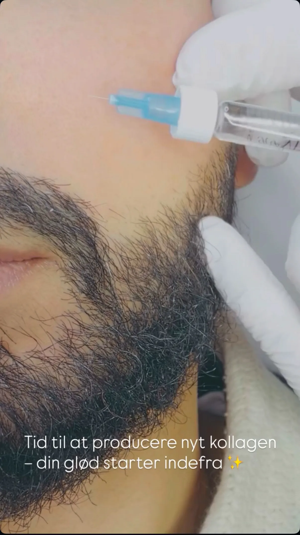 Skinbooster behandling